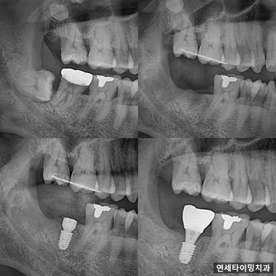 강동구 매복 사랑니, 미루면 생기는 문제와 발치 전 확인 관련 사진 2