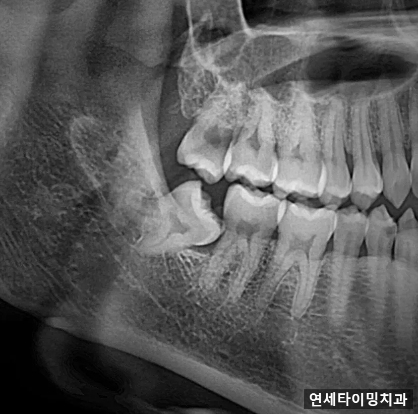 강동구 매복 사랑니, 미루면 생기는 문제와 발치 전 확인 관련 사진 3