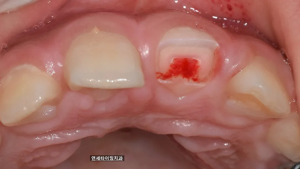 강동구 소아 앞니 파절, MTA 신경 보호와 당일 레진 수복 관련 사진 2