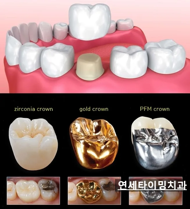 강동구 소아 앞니 파절, MTA 신경 보호와 당일 레진 수복 관련 사진 4