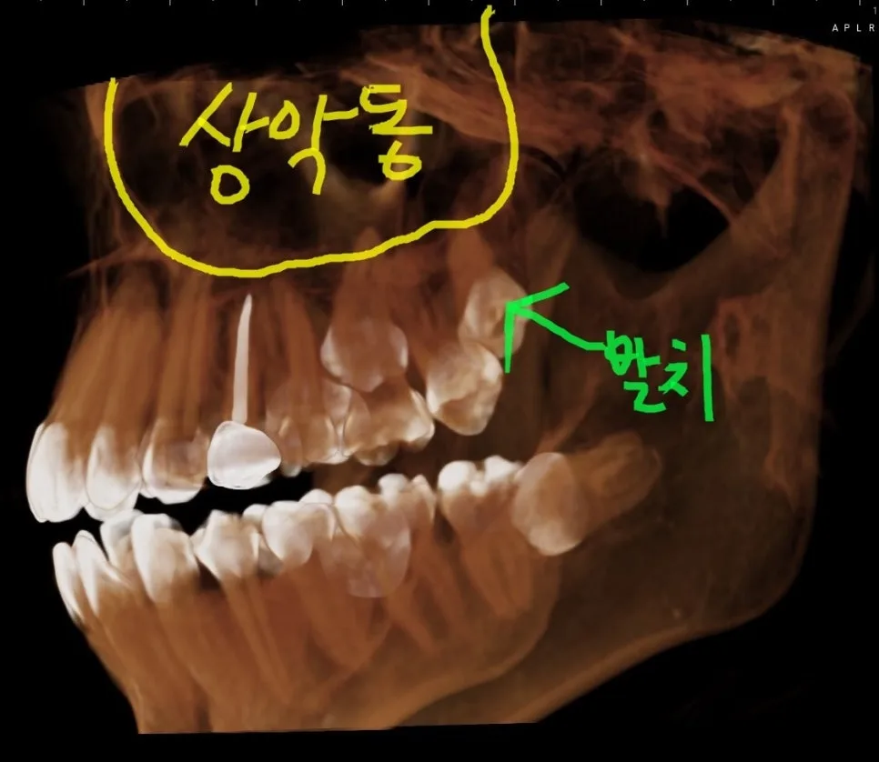 위쪽 매복 사랑니 발치와 상악동, 코로 물이 넘어가는 증상 관련 사진 4