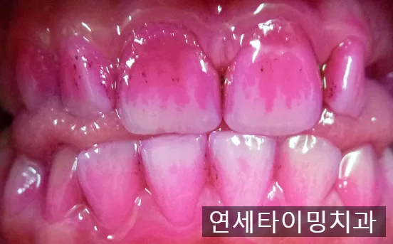 서울시 아동치과주치의 시범사업, 대상과 검진 내용 안내 관련 사진 3