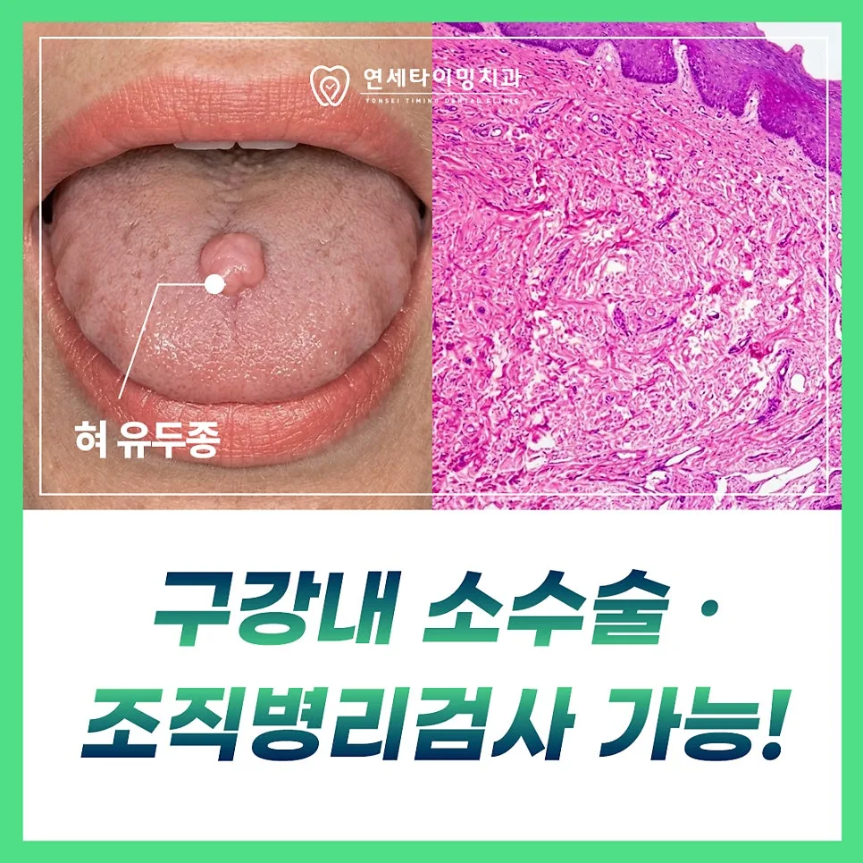 강동구 치과 입안에 혹이 생겼을 때 확인해야 할 것 관련 사진 2