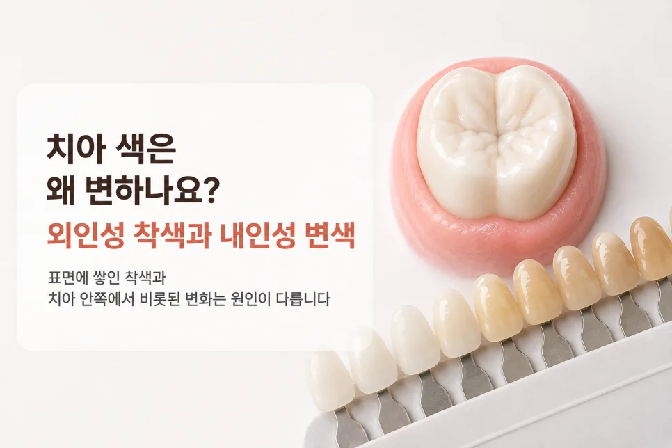 강동구 치아미백, 착색의 종류를 먼저 나누는 이유 관련 사진 3