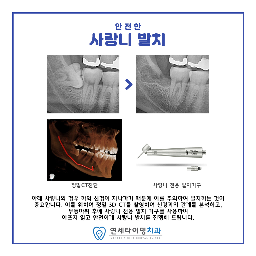 당일 사랑니 발치