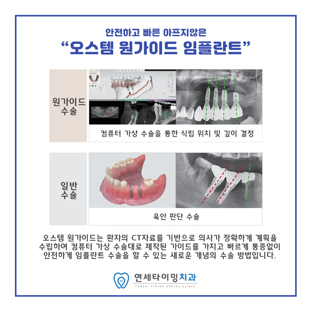 네비게이션 임플란트